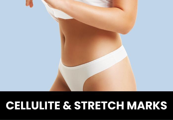 cellulite stretch marks